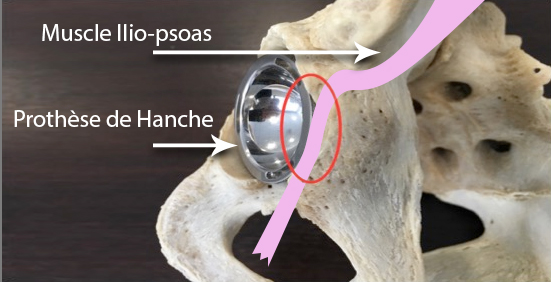 Diagnostic psoas