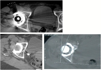 scanner psoas